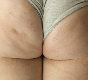 En la imagen podemos ver estrías, celulitis...en un culo de mujer