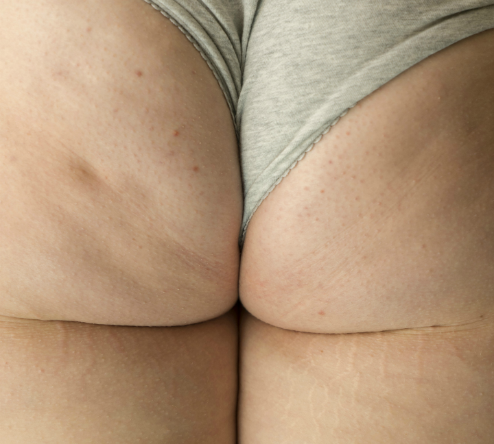 En la imagen podemos ver estrías, celulitis...en un culo de mujer